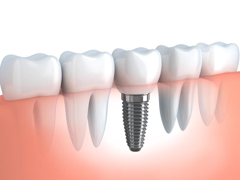 Dental Implants  Mount Vernon, WA 